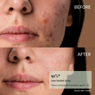 Close-up of a woman's lower face showing acne before use (top) and clearer skin after using IREN Shizen CLEARER DAYS Anti-Blemish Serum (bottom), with text stating 91% saw healed acne after two weeks.